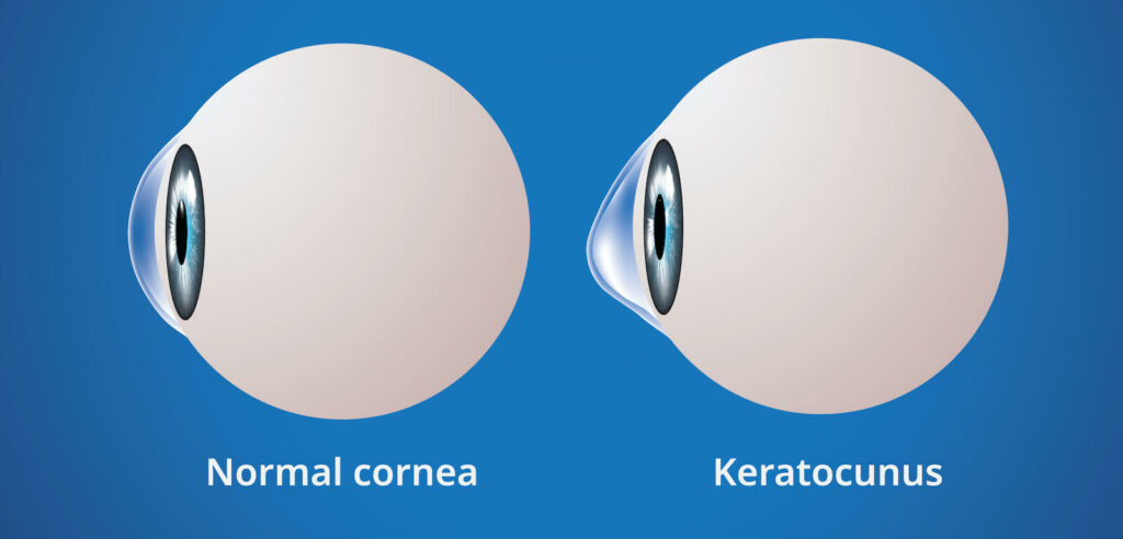 Cornea Montgomery | Keratoconus Montgomery | Montgomery Eye